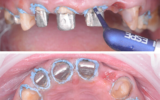 Cómo lograr una retracción gingival efectiva?